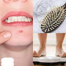 Pcos Polycystic Ovary Syndrome Atau Sindrom Ovarium Polikistik Merupakan Kondisi Terganggunya Fungsi Ovarium Pada Nostril Hoop Ring Instagram Posts Nose Ring