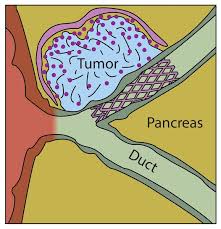 If you have diabetes, track any symptoms associated with pancreatic cancer, especially unusual weight loss and stomach pains. Implantable Device Targets Pancreatic Cancer Mit News Massachusetts Institute Of Technology