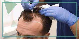 Con la sessione di trapianto di capelli con il metodo fue senza tagliare dei capelli il/la interessato /a ha la possibilità di ripristinare . Trapianto Di Capelli Senza Rasatura Znz Grup
