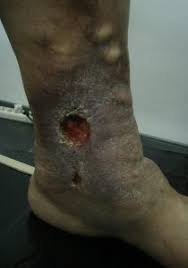 După dezinfectarea cu apă oxigenată se tratament corect pentru escara. Ulcer Varicos Ce Este Simptome Tratament Newsmed Ro