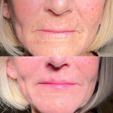 Unveil a new level of radiance with our Black Friday Deal! ✨ Purchase a  series of 6 Hydrafacials and enjoy an exclusive $100 off! 🌟 Hurry, this  spectacular offer is available until