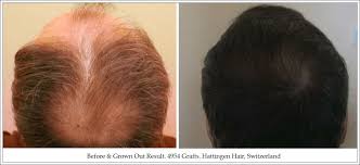 Crown Or Vertex Surgical Hair Restoration Hair Restoration Hair Hair Transplant