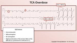 Founded in hackney, east london, tca has been creating sports clothing that fits, performs & lasts since 2012. Tca Overdose On Ekg Sinus Tachycardia Qrs Prolongation Grepmed