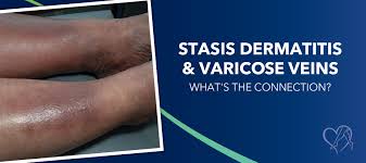 Image result for Stasis Dermatitis