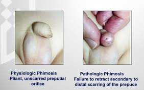 Image result for Phimosis