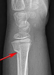 When the cast is removed, the wrist and elbow joints may be stiff for 2 to 3. Clinical Practice Guidelines Distal Radius And Or Ulna Metaphyseal Fractures Emergency Department