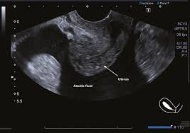 Ovarian cancer has a lifetime risk of around 2% for women in england and wales. Recognition Of Possible Gynaecological Cancer Chapter 15 Ultrasound In Reproductive Healthcare Practice