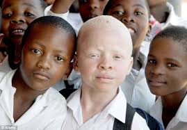 Image result for causes of albinism