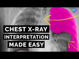 Image result for Chest XRay Interpretation