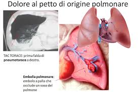 L'embolia polmonare rappresenta la terza causa di patologia cardiovascolare dopo l'infarto miocardico e l'ictus statisticamente i soggetti maggiormente colpiti da embolia polmonare sono le donne. Dolore Toracico Di Origine Polmonare
