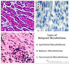 Mesothelioma Asbestos Images Diagrams Graphs