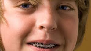 Zahnregulierungen, umgangssprachlich auch zahnspangen genannt, sind kieferorthopädische zahnspangen werden zum teil individuell im zahntechnischen labor hergestellt und bestehen aus. Irgendwie Fand Ich Es Cool Eine Zahnspange Zu Bekommen