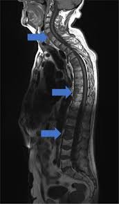 Other tests include blood monoclonal immunoglobulin and radiology tests to determine the extent of bone lesions. Multiple Myeloma With Hypoechoic Liver Nodules
