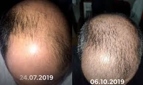 Mavi Serum Oncesi Ve Sonrasi