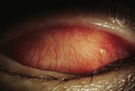 Image result for Allergic Conjunctivitis