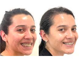 🇺🇸 Honored to present at the ASTMJS Annual Meeting as a society member!  🇺🇸 It was a privilege to participate as a member of the American Society  of TMJ Surgeons (ASTMJS) in