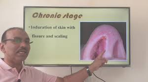 If there is a permanent white patch which fails to heal and b. Nasal Vestibulitis Urdu Patient Teaching Programme Youtube