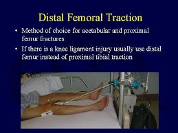 The purpose of this type of traction is to decrease painful muscle spasms that accompany fractures. Closed Reduction Traction And Casting Techniques David Hak