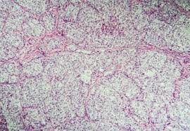 This kind of cancer can be difficult to detect because it often doesn't cause any symptoms until later stages. Artificial Intelligence Can Predict Survival Of Ovarian Cancer Patients Imperial News Imperial College London