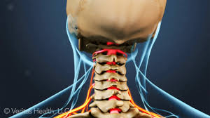 A cervical foraminotomy is a surgical procedure done at the front or back of the neck 