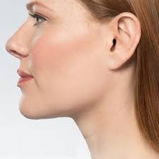 Kybella