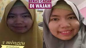 Wa 0812 5828 1208 L Cara Memutihkan Wajah Pria Trulum Skincare Ampule Trulum Adalah Produk Skincare Synergy Yang Sensasional Spek Wajah Pria Wajah Wajah Wanita