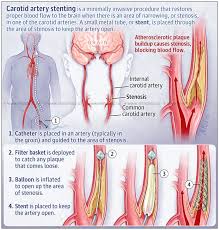 View an animation of blood flow (link opens in new window). Min The Internal Carotid Artery And Its Branches Occlusion Syndromes