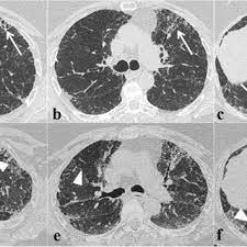 Extra pulmonary presentation of nsg is very rare. Pdf Fibrotic Hypersensitivity Pneumonitis Diagnosis And Management