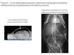 Image result for Necrotizing Enterocolitis