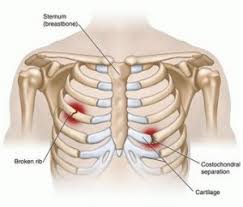 Rib fractures are much less common in kids because their ribs are more springy (more cartilage and less bone compared to an adult) and require considerable force to break. Rib Fracture And Pneumothorax Complication Sportsmd