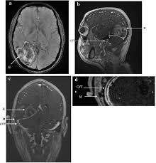 Was sind ursachen für eine sinusvenenthrombose? Zerebrale Sinusvenenthrombose Und Intrakranielle Blutung Als Folge Einer Otorhinolaryngologischen Komplikation E Schaeffer Et Al Int Care Med 2016 10 1007 S00134 016 4370 Z A 23 Year Old Man Presented To The Emergency Department With A 3 Day History