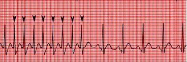 Image result for Synchronized Cardioversion
