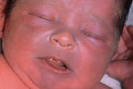 Image result for Croup