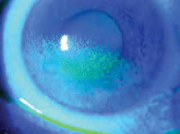 Image result for Dry Eye