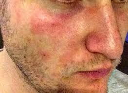 Verursacht wird pv durch den hefepilz malassezia furfur. Welche Hauterkrankung Kann Das Sein Gesicht Dermatologie Beauty