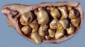 Pin On Gallbladder Removed Diet