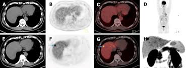 Positron Emission Tomography For Hepatocellular Carcinoma