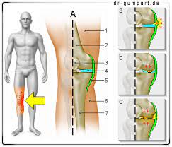 Je nach schmerzlokalisierung spricht der orthopäde von vorderen, inneren, äußeren und periartikulären. Knieschmerzen Auf Der Innenseite Was Steckt Dahinter