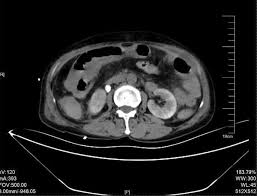 The Importance Of Good Bowel Preparation During Colonoscopy - Youtube