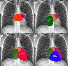 Chest X Ray Basic Interpretation Radiology Imaging Radiology Cardiac Anatomy