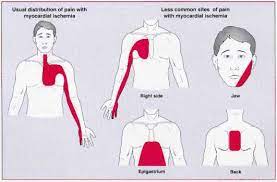 Sakit ulu hati karena maag. Kenali Ciri Ciri Nyeri Ulu Hati Yang Mengancam Jiwa Halaman All Kompasiana Com