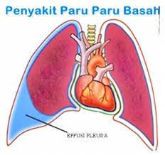 Tips Cara Ampuh Menghindari Paru Paru Basah Paru Paru Penyakit Medis