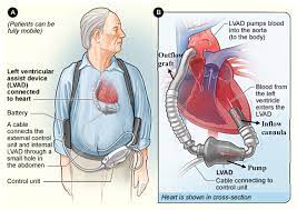 Jcm Free Full Text Left Ventricular Assist Devices 101 Shared Care For General Cardiologists And Primary Care Html