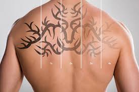For questions or comments, please use the information listed here. On Demand Laser Tattoo Removal Atlanta Ga