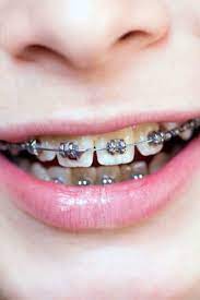 Uses, pain relief, foods to eat. Do Braces Hurt What To Expect When You Get Braces