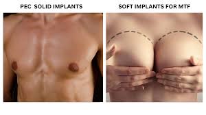 Image result for Breast Augmentation