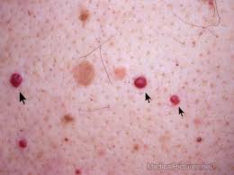 Cherry angiomas are benign growths made up of blood vessels, which give them their characteristic red color. Bromine Poisoning The Cause Of Cherry Angiomas Iodine Resource Com Don T Play Around With Your Precious Health