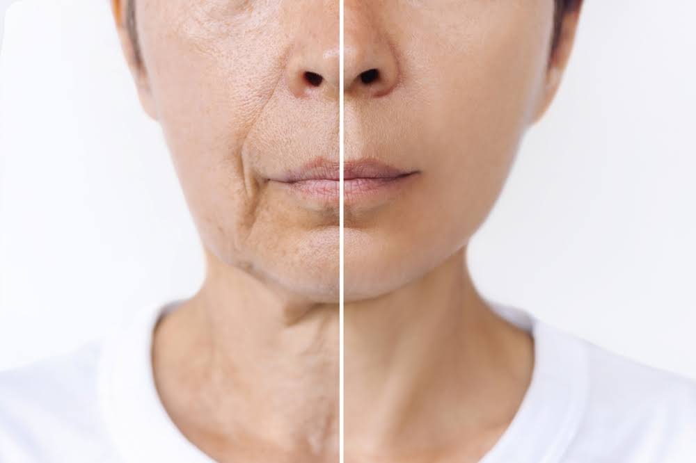 Laser Skin Tighteining product image