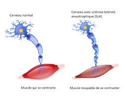 Prévalence de la maladie de charcot Maladie De Charcot Age Premiers Symptomes Esperance De Vie
