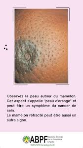 🔴📣🔴📣 #cancerdusein Le signe le plus classique du cancer du sein est une bosse ou une enflure dans un sein. Soyez donc attentifs/intensives à un tel changement. D'autres signes possibles de